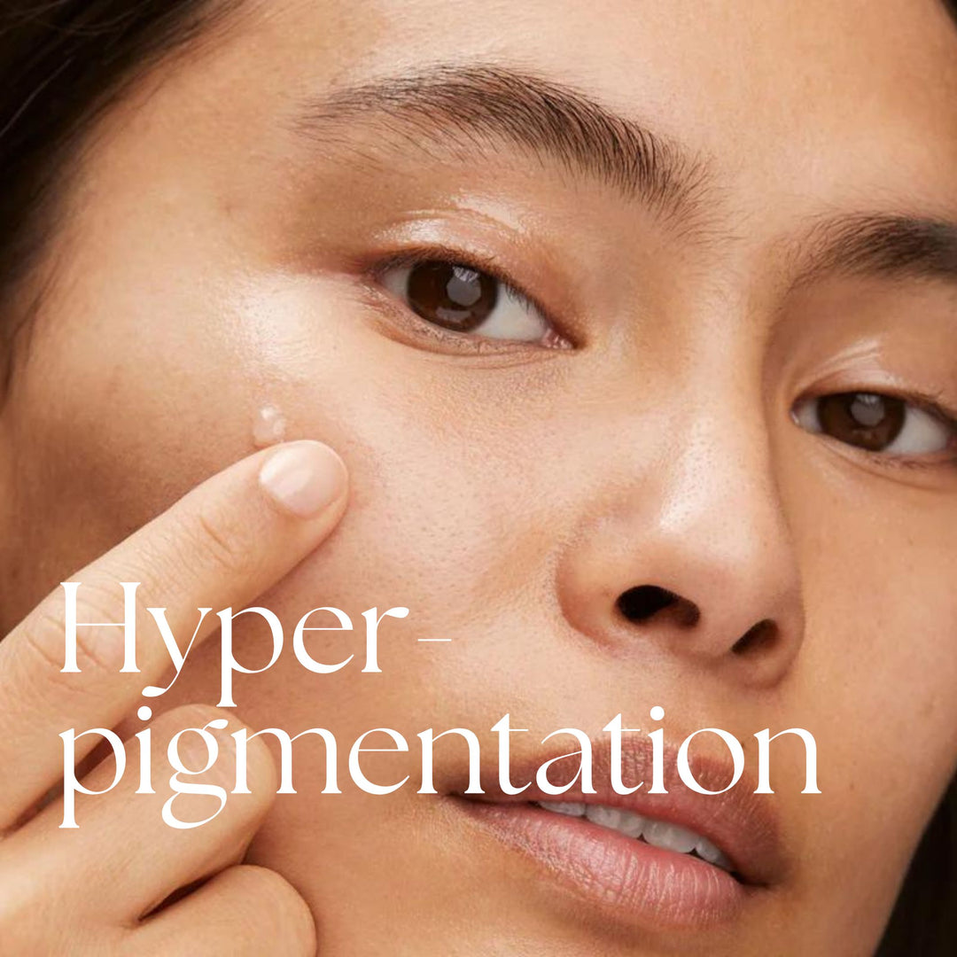 Hyperpigmentation